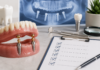 7 Recall Checks for a Ball-Retained Implant Overdenture Ball-Retained Implant Overdenture