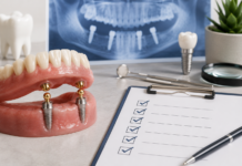 7 Recall Checks for a Ball-Retained Implant Overdenture Ball-Retained Implant Overdenture