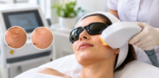 Say Goodbye to Sun Damage with Advanced IPL Photofacials Sun Damage with Advanced IPL Photofacials